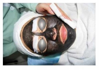 Laser pikosekundowy, Nd-Yag, peeling węglowy Kod producenta SARAH BB-58