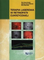 Terapia laserowa w retinopatii cukrzycowej