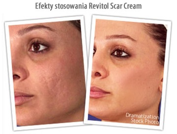 Revitol Scar Cream старые шрамы, растяжки, пятна США