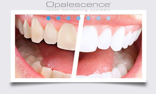 OPALESCENCE PF 1x 16% ГЕЛЬ ДЛЯ БЕЛЕНИЯ ЗУБОВ США